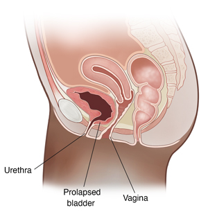 cystocele