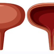 overactive bladder