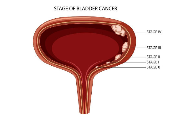 Bladder Cancer: Symptoms, Causes & Treatment