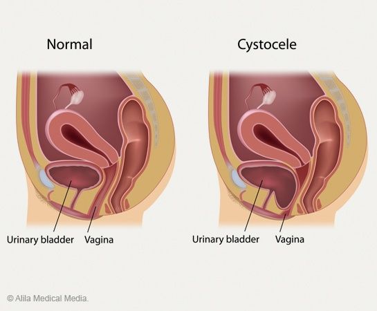 Cystocele (Fallen Bladder)