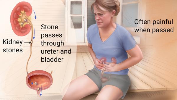 cystocele symptoms