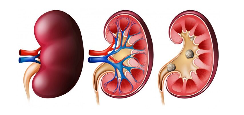 What Is Kidney Cancer?