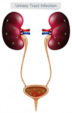 What Is a Urinary Tract Infection (UTI)?