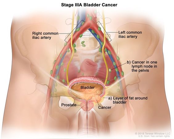  common is bladder cancer