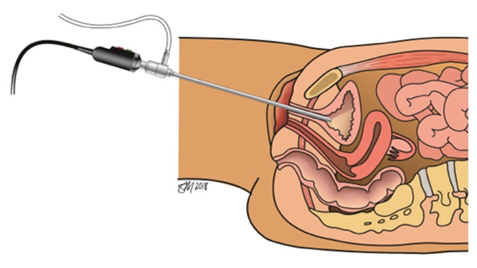 pelvic Floor Dysfunction 