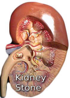 Understanding Renal Stone Diseases: Causes, Symptoms, and Treatment: