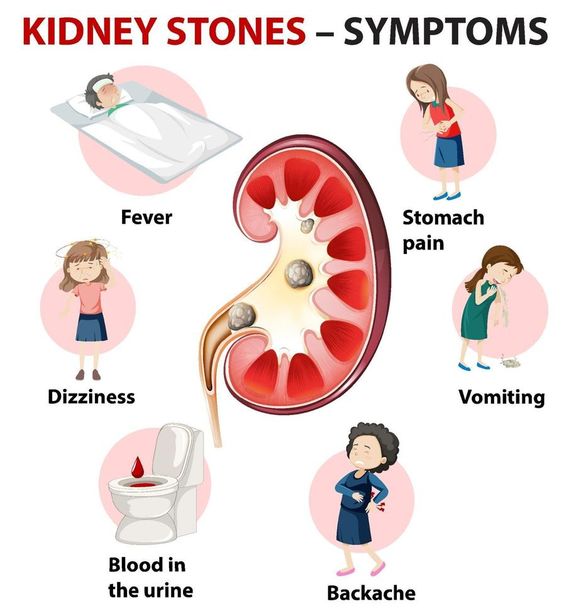 renal stone